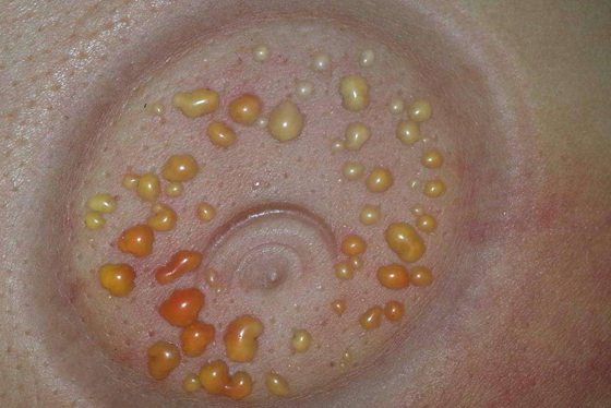 拔火罐為什么會起水泡,拔罐出水泡怎么辦