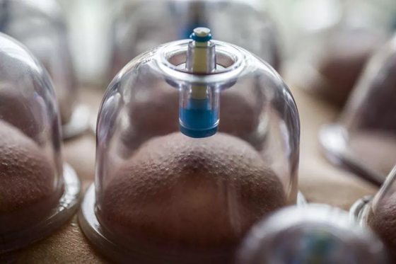 拔火罐為什么會起水泡,拔罐出水泡怎么辦