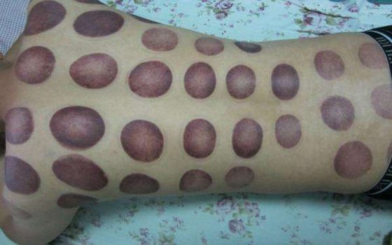 拔火罐為什么會起水泡,拔罐出水泡怎么辦