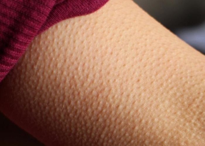 人為什么會(huì)起雞皮疙瘩